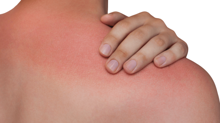 Read more about the article Is Lyme Disease Contagious? Everything You Need to Know