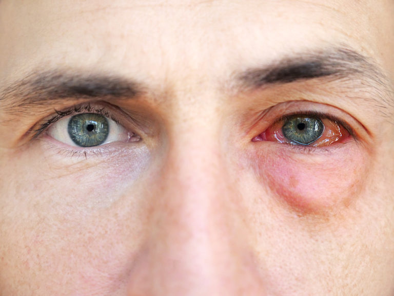 Read more about the article Can Gonorrhea Really Infect Your Eyes? Here’s What You Need to Know