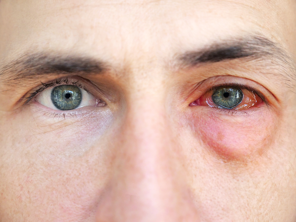 You are currently viewing Can Gonorrhea Really Infect Your Eyes? Here’s What You Need to Know
