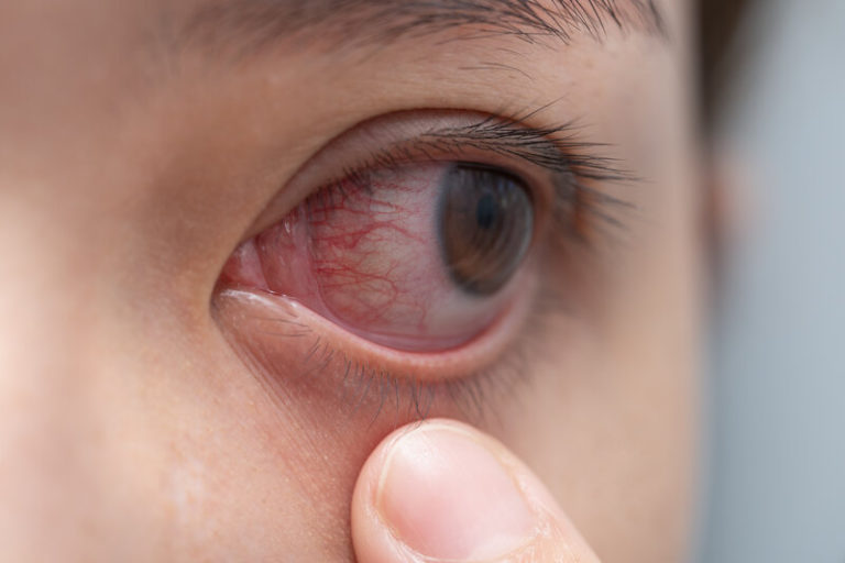 Read more about the article Herpes in the Eye: What You Need to Know to Protect Your Vision