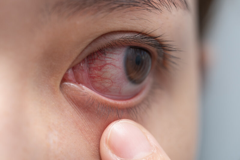 You are currently viewing Herpes in the Eye: What You Need to Know to Protect Your Vision